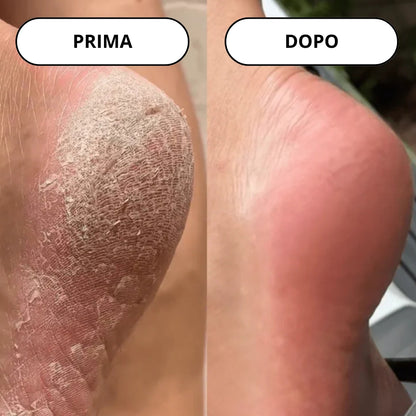 Lima Elettrica per la Rimozione dei Calli