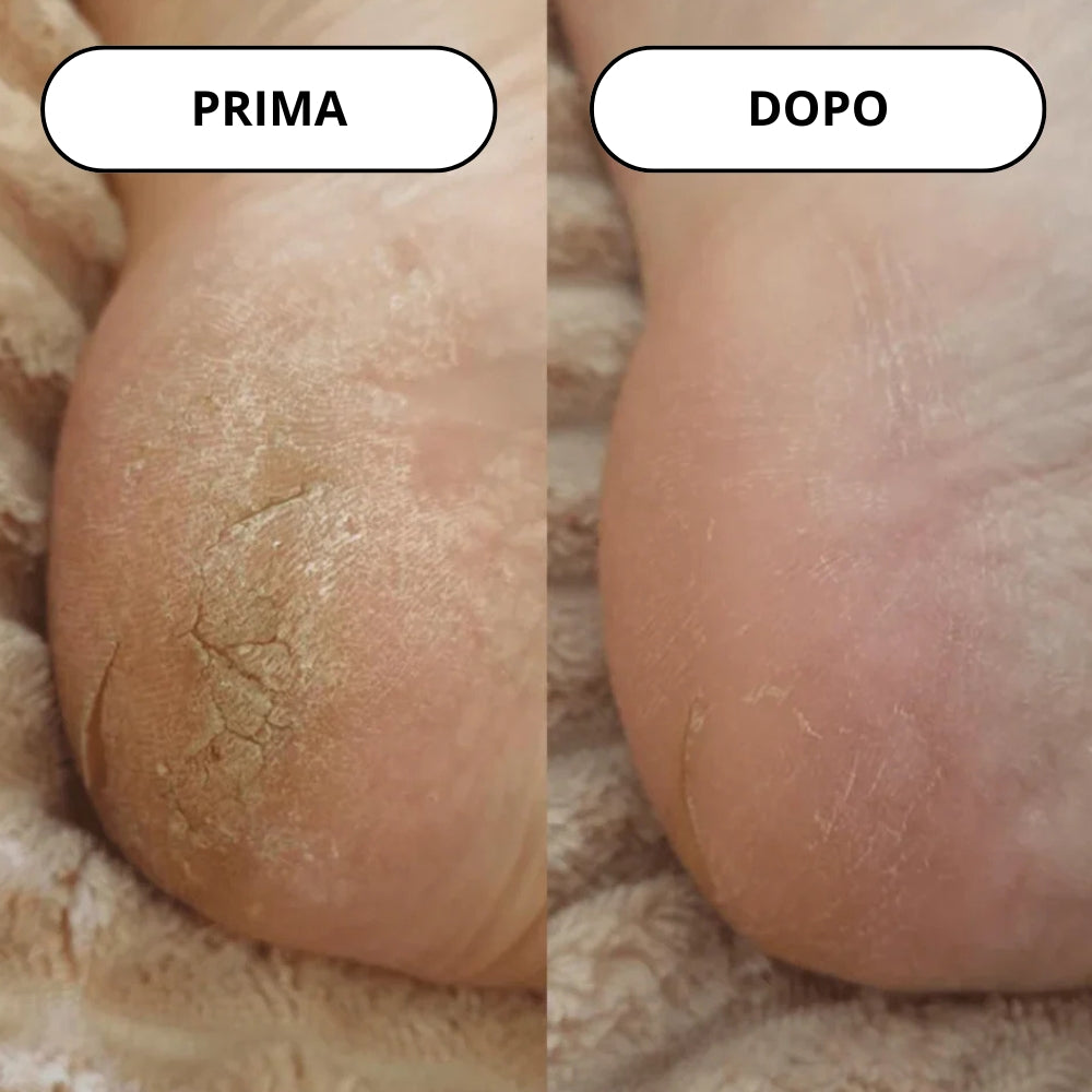 Lima Elettrica per la Rimozione dei Calli