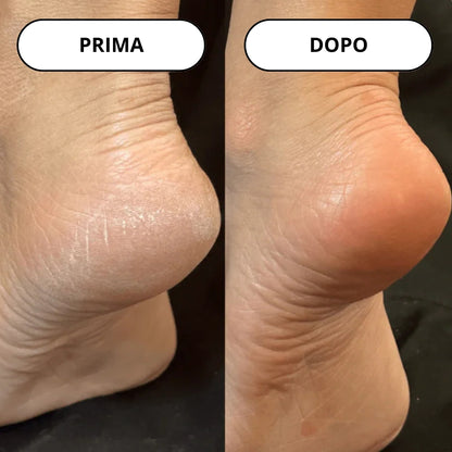 Lima Elettrica per la Rimozione dei Calli